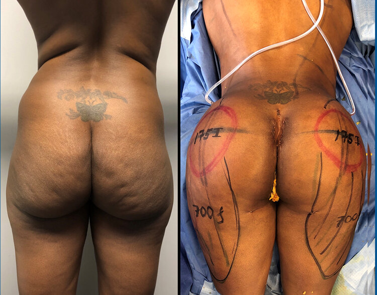Before and After - Composite Butt Augmentation